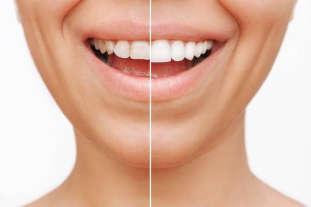 close-up shot of a person's before and after teeth after dental restoration