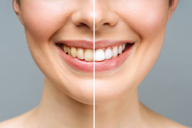 image of a woman’s teeth before and after whitening