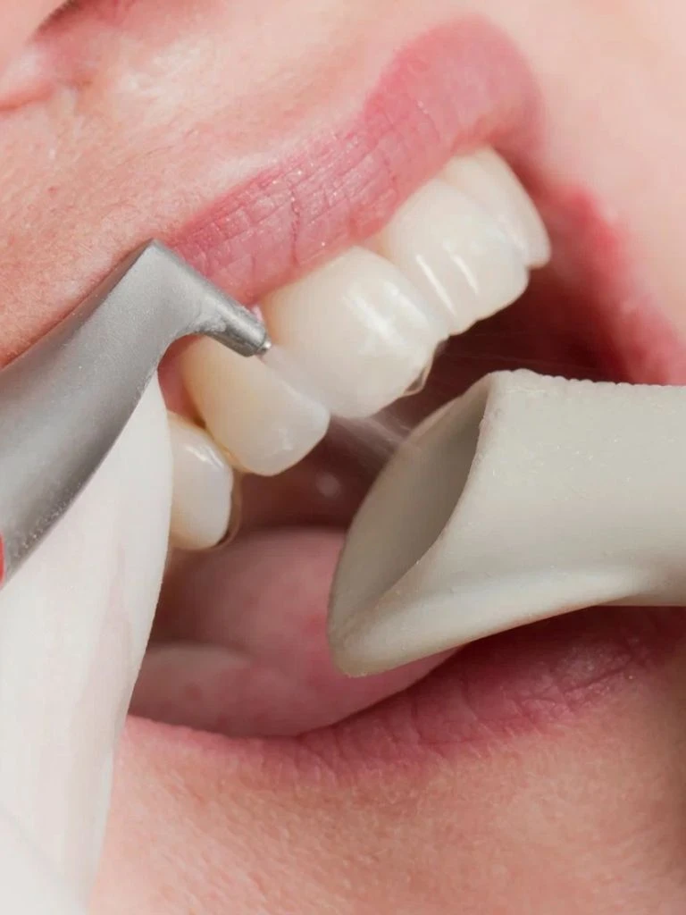 Teeth Cleaning Murray Hill