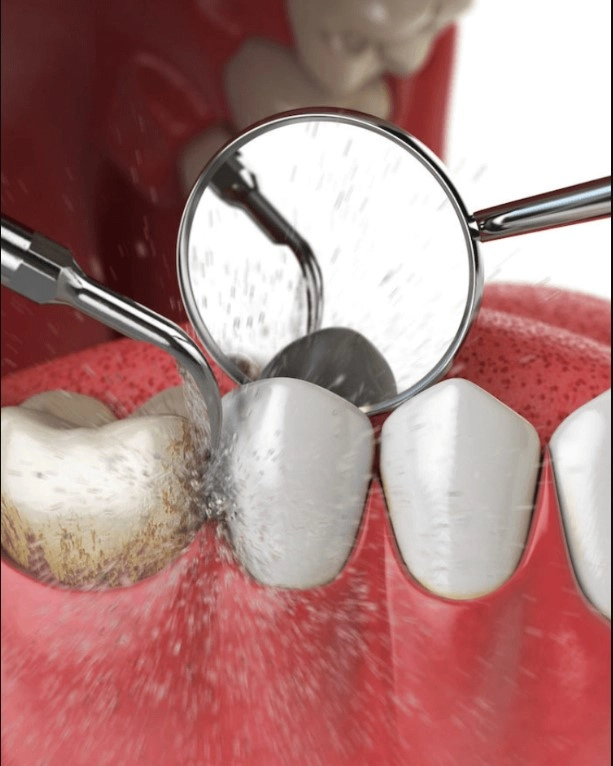 Teeth Cleaning Kew Gardens Hills